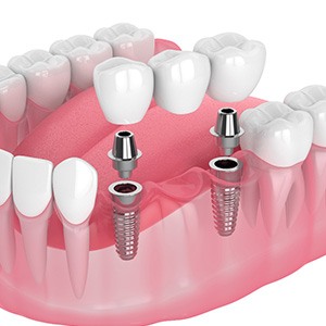 Illustration of an implant bridge