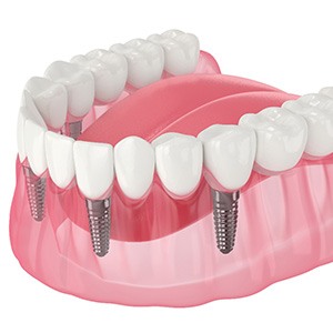 Illustration of an implant denture