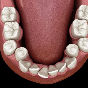 Illustration of crowded teeth