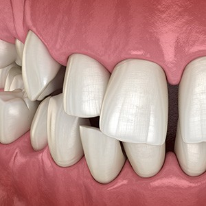 Illustration of gapped teeth