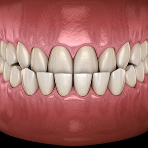 Illustration of an underbite