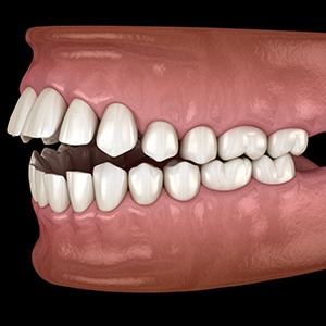 Illustration of an open bite