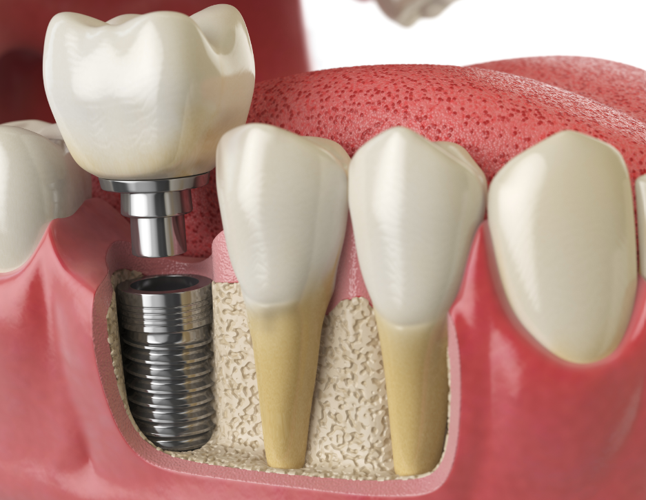 3D image of a dental implant